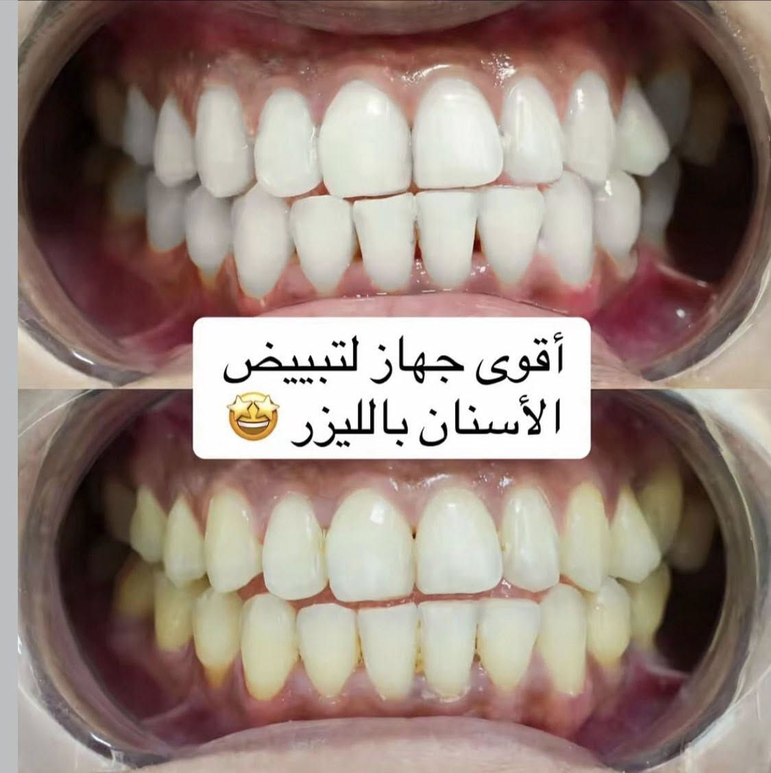 �✨ عروض عيد الأضحى في عيادة الرسالة ✨🎉
خصومات قوية تصل إلى 50% 😍🦷
على:

🔹 تنظيف الأسنان
🔹 إزالة التكلسات والتصبغات
🔹 تبييض الأسنان بالليزر ✨

اغتنم فرصة العيد وخلي ابتسامتك أنظف وأجمل بثقة 🤍

📍 حي الرسالة – مقابل شارع عشرين حي الإطارات من جهة الرسالة
📞 للحجز والاستفسار: ***********
