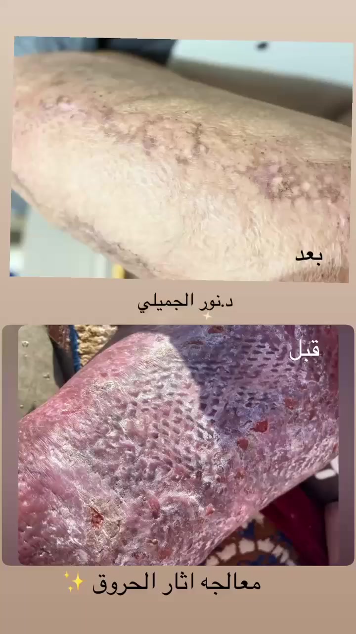 السلام عليكم 
رمضان كريم 
دوام العيادة راح يكون بعد الإفطار يومياً من ساعة ٧ ونص للساعة ١١ مجمع فينيسيا الطبي الشرقاط السايدين مقابيل اهل الاسمنت قريب سنتر الصلطان الحجز ولاستفسار عل ارقام التاليه  ***********
***********
