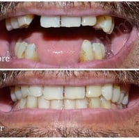 احد محتاج تعويض لاسنانه المفقوده ونعوضها بطقم جزئي يتفضل يراسلني 07712...