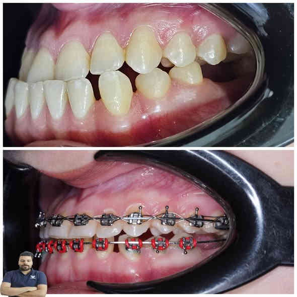 عذراء كانت تعاني من تقدم بالفك السفلي كدرنة نعدل اسنانهة ونرجع ابتسامتهة خلال مدة سنة ونص من العلاج

العنوان / المسيب / شارع البلدية / مقابل دكتور جعفر وفي للاطفال 

للحجز والاستفسار 
***********
***********
