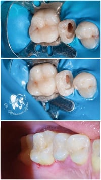 حشوات ضوئيه • إعادة تفاصيل السن • مجمع اليمامه