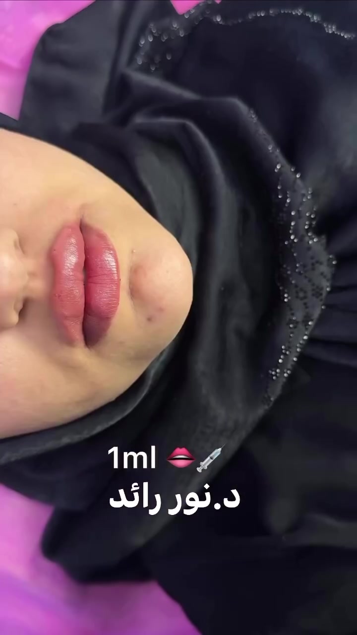 تجديد حقن بعد مرور سنة ونص على الحقن الاول/شغل الدكتورة نور رائد 

العنوان 📍📍عيادة بيرلي (نبتون)
الحمزة الشرقي جهة شارع الملاحة مقابيل صيدلية نجلاء الشيباني 
قرب مطعم علي الجبوري واتساب او الاستفسار ***********
