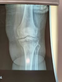 النقرس الكاذب • دكتور روماتيزم • السماوة