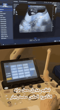 مراجعتنا العزيزه لديها بنات ٢ وقمنا بعد اشاءة رب العالمين بتنظيم جدول الحمل بالذكر فكانت نتيجة الحمل ذكر بعد انتضار سنوات .لله الحمد والشكر ونسأل الله ان يجعلنا سبب في سعادة الاخرين 

 #الدكتورة #الماس #محمد #جبار 
اخصائية في جراحة الأمراض النسائية والتوليد
 وعلاج العقم ورعاية الحوامل 
👩🏼‍🍼عمليات قيصرية 
👩🏼‍🍼عمليات استئصال الرحم والعقد الليفية واكياس المبايض 
👩🏼‍🍼عمليات الناظور التشخيصي والعلاجي لحالات العقم
👩🏼‍🍼عمليات تجميل المهبل 
👩🏼‍🍼اجراء الولادة الطبيعيه بدون ألم 
👩🏼‍🍼رفع الأورام السرطانية 

للحجز والاستفسار مراسلة الصفحة او الاتصال على الرقم التالي
***********📞
***********

أو زورونا في المجمع العنوان :
📍مجمع عرفة الطبي. - كركوك _حي العسكري -بداية السايدين
