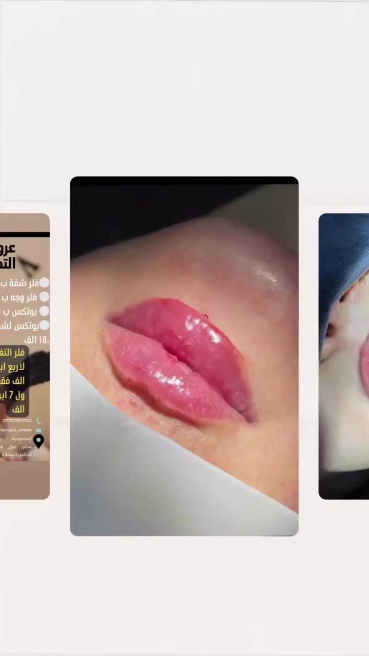 #explorer #explore #explorepage عروض العيد 
فلر - بوتكس - ابر نضاره 
العنوان - المحمودية - حي الموظفين - مجاور اسواق هبي دي 
للحجز *********** #د_سمارة_عامر #فلر
