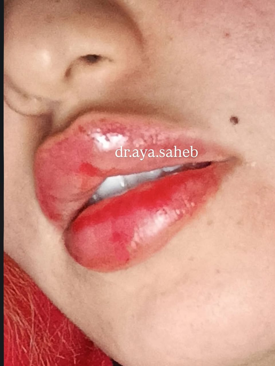 مجموعة صور مختلفة من مراجعاتي بعد حقن فلر الشفة ♥️ صورة احلى من صورة 🍬😍
للحجز والاستفسار/***********
الديوانية 📍
