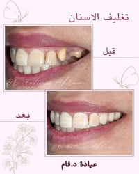 تغليف الاسنان وتعويض الأسنان المفقودة بجسر ثابت من الزاركون 🦷 واكيد ال...