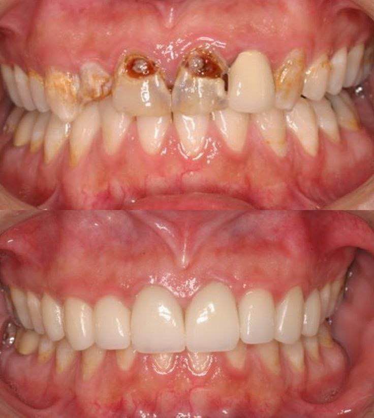 السلام عليكم الي محتاج 
حشوه 
قلع 
تركيب اسنان 
تنضيف 
نشتغل اله بالجامعه تحت اشراف اطباء اختصاص علما ان العمل مجاني 
هذا رقمي بي واتساب الي يحتاج شي يراسلني 
***********

