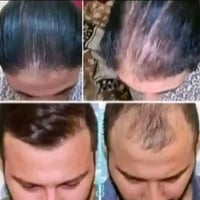 بديل زراعة الشعر • إنبات اللحية • نتيجة ٣٠ يوم