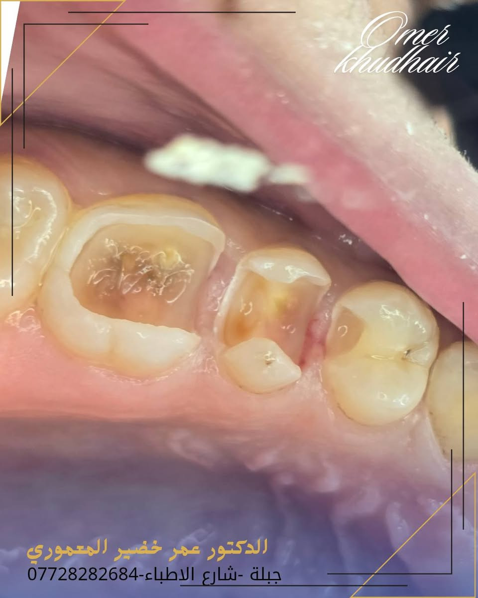 تسوس كلش عميق لكن تم التنظيف بحذر وكان قريب على الجذر خليت مادة تحمي العصب وبعدها الحشوة واهتميت يكون نفس شكل السن الطبيعي 

الدكتور عمر خضير المعموري-Omer Almamori 
***********
