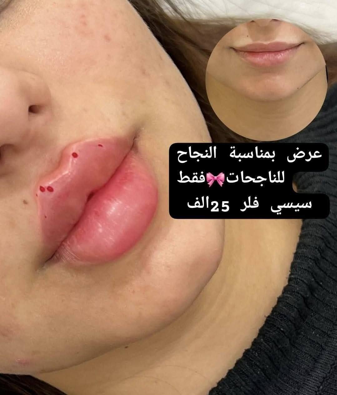 🔥✨ بمناسبة عيد الضحى ✨🔥
💆‍♀️ تسوين حف + بشرة
💇‍♀️ تسوين صبغ + ميش
وغيرها هوايــــة عروض ومفاجآت داخل السنتر ✨💖
⏰ العرض مستمر فقط لغاية الساعة 4 العصر
🚨 لا تفوتون الفرصة والبنات دللو نفسكم ويانه
━━━━━━━━━━━
✨🌸 أقوى عروض عيد الأضحى المبارك 🌸✨
من داليا بيوتي 💖
دللي نفسج بأفخم الخدمات وأقوى الأسعار 🔥
💇‍♀️ عروض الشعر 💇‍♀️
✨ صبغ ميش للشعر القصير (الكاريه) — 15 ألف فقط
✨ صبغ فقط — 10 آلاف فقط
✨ صبغ ميش للشعر الوسط للكتف — 25 ألف فقط
✨ صبغ فقط — 15 ألف فقط
💖 الشعر الطويل والثخين
عليه خصومات قوية داخل السنتر 😍
✨ تخصيل جميع الأطوال
ماعدا الشعر الطويل — 35 ألف فقط
✨ عروض البروتين — 25 ألف فقط
يعالج الشعر التعبان والمتقصف والمحترك والمطاط ✨
━━━━━━━━━━━
💃 عروض التسريح 💃
✨ تسريح للشعر القصير — 20 ألف فقط
✨ تسريح للشعر الوسط للكتف — 30 ألف فقط
💖 الشعر الطويل والثخين
عليه خصم مميز داخل السنتر ✨
━━━━━━━━━━━
👁️ عروض الرموش 👁️
✨ رموش طرفية — 5 آلاف فقط
✨ رموش كاملة — 10 آلاف فقط
━━━━━━━━━━━
🌸 خدمات الوجه والعناية 🌸
✨ حف — 5 آلاف فقط
✨ شمع للوجه — 5 آلاف فقط
✨ شمع للرقبة — 5 آلاف فقط
✨ تنظيف قدم — 5 آلاف فقط
✨ تنظيف أيد — 5 آلاف فقط
✨ تنظيف بشرة — 5 آلاف فقط
✨ هايدروفيشل — 5 آلاف فقط
✨ تقشير كاربوني — 5 آلاف فقط
━━━━━━━━━━━
💖 عروض الشيرة 💖
✨ شيرة بكيني — 5 آلاف فقط
✨ شيرة الإبط — 5 آلاف فقط
✨ شيرة الرقبة — 5 آلاف فقط
شيرة جسم كامل 15  الف
━━━━━━━━━━━
💅 عروض الأكرلك والأظافر 💅
✨ أكرلك + جلش + دزاين — 15 ألف فقط
✨ جلش فقط — 5 آلاف فقط
✨ دزاين فقط — 5 آلاف فقط
━━━━━━━━━━━
✨ عروض الليزر ✨
✨ ليزر الوجه — 10 آلاف فقط
✨ ليزر البكيني — 10 آلاف فقط
✨ ليزر الإبط — 10 آلاف فقط
━━━━━━━━━━━
🌸✨ افتتاح فرعنا الثاني ✨🌸
سوينالكم عرض خاص اليوم وباجر والسبت فقط 💅
🔥 أكرلك + جلش + دزاين بـ 15 ألف 
شيرة جسم كامل 15 :
بغداد الجديدة —✨
📌 الفرع الثاني:
بغداد الجديدة — نعيريه✨
فرع كنيسة مريم العذراء 
فرع سكلة الامي 
📞 للاستفسار والحجز:
*********** — واتساب متوفر 
@إشارة ✨️ عروض العيد  ✨️
تغيير شامل فلر كوري 150الف  مع ابرة نضاره
#تغيير_للأفضل #تغيير_شامل #تفتيح
