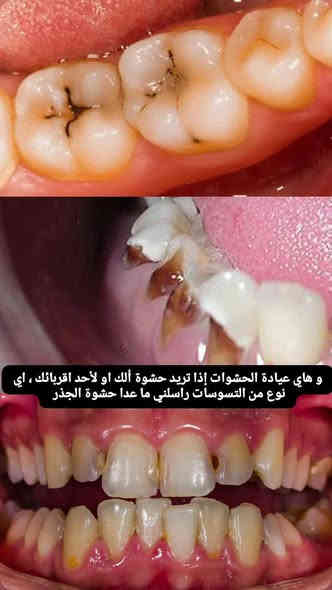 من رخصة الأمن
السلام عليكم شلونكم شباب إن شاء الله بخير💐 ، اي شخص يحتاج حشوة ، قلع ، تنظيف ، أو فحص لاسنانه او حالته مشابهه للصور المرفقة وتحتاج علاج خل يتواصل وياي على الخاص او على الواتساب *********** و حته احجزله فوراً علما أنه العلاج مجاني و تحت إشراف كادر طبي متخصص جدا في كلية طب الأسنان جامعة القادسية .
