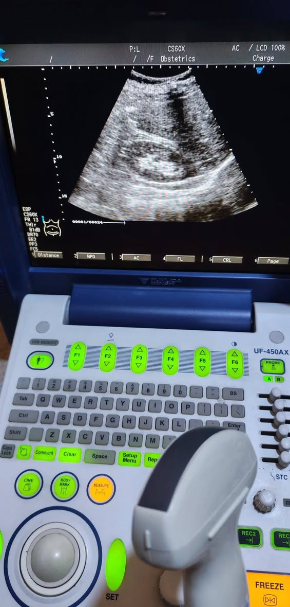 (( جهاز سونار للبيع ))
- جهاز سونار نوع فوكودا Dinshi مستعمل وبسعر مناسب جدا ...
 & اطبائنا الكرام &
- يوجد لدينا جهاز سونار مستعمل :-
اسم الجهاز :  فوكودا Dinshi
سنة الصنع : 2017
المنشا : ياباني
الملحقات : بروبين( كونفكس + فجاينل)  convex + T. V
نوع الجهاز : 2D
مع جميع فحوصات
حالة الجهاز : ممتاز
وضوح الصورة : ممتاز
- للحجز والاستفسار يرجى مراسلة الصفحة او الاتصال على الرقم التالي :-
***********
وبسعر جدا جدا مناسب 💥💥

#أجهزةطبيةمستعملة #أجهزةسونار #سونار #اجهزةطبية #سونارمستعمل #سونارات #سامسونك #اجهزةطبيةجدبدة #اشعة #اشعةوسونار #اطباءسونار #سونرات #مهندس #sonoace #مستلزمات #طبية #فيلد #جل #كونفكس #فجاينل #لينير #4D #ob #gyn #abdomin #ايكو
#adaltecho #exam #GE #volusionp8
