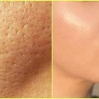 ابر نضاره • فلر • بشرة صافيه