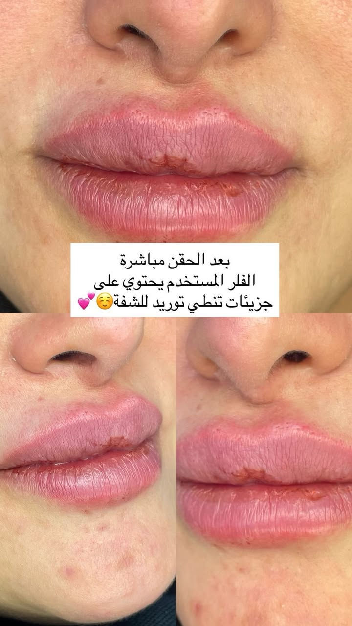 زيركون بسماية لطب الاسنان والتجميل
كلشي متوفر بالنقد وبالتقسيط بدون مقدمة للموظفين والمتقاعدين 

عرض العيد الكل ينتظرة سارعو الحجز
- فلر كوري+بلازمة مفعلة  100 
- فلر بلجيكي+بلازمة مفعلة 125
ومتوفر فلر سويسري و ايطالي براند
- تذويب فلر فوري — ٣٥ ألف
- ⁠بوتوكس باودر لكل الوجه 125
- ⁠ميزو هالات وتصبغات ومكس تفتيح 75
- ⁠بلازمة مفعلة+بي ار بي للتساقط 50
- ⁠ابر نظارة براند بجميع انواعها 

الحقن يتم بيد طبيبات الاختصاص الدكتورة زهراء نجاح وباستخدام مواد أصلية مفحوصة من وزارة الصحة لضمان نتيجة آمنة وجميلة 💎
———————————————————
—العنوان بغداد-مقابل مجمع بسماية السكني-السايد الراجع من بغداد-على الخدمي .
  للحجز+اسفسار ***********زيركون بسماية
