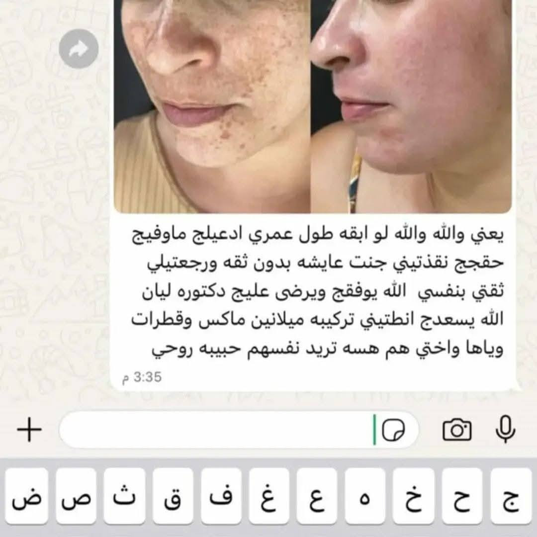 تركيبه الميلانين  الماكسس وقطراتها 🖤
تدرون بهل تركيبة
راح تحصلون ع بشرة زجاجية
معالجة حب الشباب
ازاله الكلف والتصبغات والنمش العميق ولسَطحي
توحيد لون البشره وازاله التصبغات حول الفم والعنيده
تبيض وتوريد ونعومه خياليه 🖤


**إذا كنت صاحب هذا الإعلان وتريد حذفه لأي سبب، رجاءا أرسل رسالة إلى الدعم الفني**