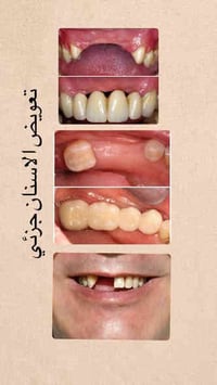 اهتمّ بابتسامتك اليوم مع أقوى عروضنا في عيادة الأسنان!  📌 حشوات أسنان ...