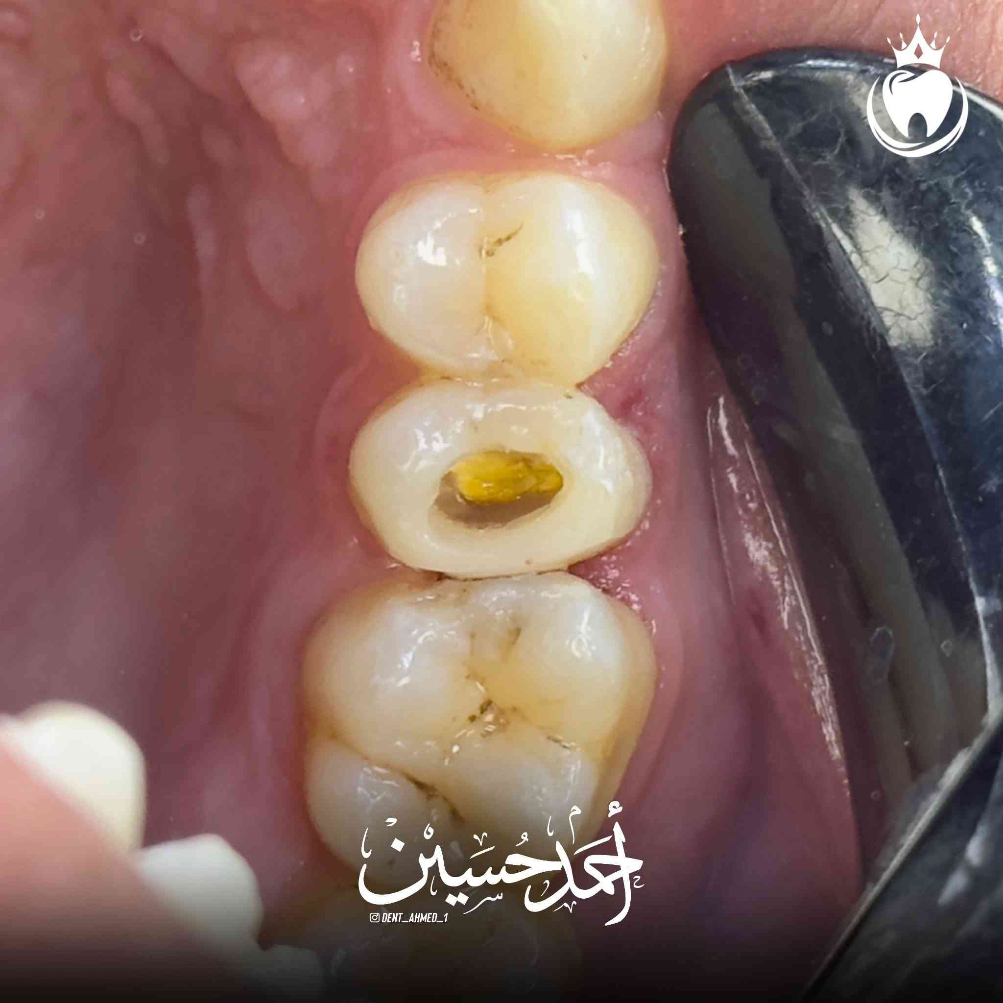 و كالعادة مراجعنا يشكو من الم مستمر في السن الضاحك العلوي و العلاج حشوة جذر مع حشوة تجميلية و اختفاء الالم و لله الحمد

الدكتور أحمد حسين الطعماوي 
المجمع الطبي الحديث مجاور مرطبات كرزة
التواجد جميع ايام الاسبوع بعد صلاة العصر الى الساعة ٨:٠٠ مساءََ
للحجز و الاستفسار :***********
