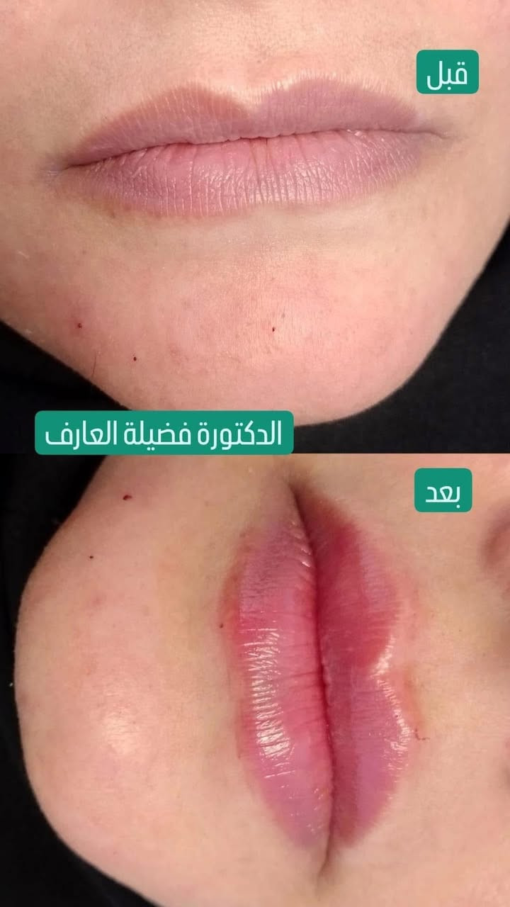 د. فضيلة العارف ❤️
غنيه عن #التعريف قمه الاخلاق والتعامل الراقي والشغل الممتاز من كل 
النواحي تجميل اطفال نسائية

  د. فضيلة العارف
عمليات #جراحية وغيرها💋✅
متقصر ويا كل #المراجعين واي احد عنده استفسار متقصر ويا ولكل مجربها ويعرفها 
تتواجد حتى في ايام العطل ✅✅
قسم من شغلها بالتجميل والفلر ✅⬇️
ماعليكم بس تجون #تفحصون حتى التحاليل توصل الكم ع واتساب اكيد تحاليل  من عيادات الوتد الطبية في بسماية
مختبر الوتد الطبي التخصصي في بسماية اضبط تحاليل واجهزة حديثة والنتيجة سريعة والعلاج ايضاً يوصل الكم للباب من مجمع وتد بسماية الطبي التخصصي  والتوصيل مجاني ايضاً 💋💋
تتواجد يومياً العنوان /الشارع العام مجاور سدن ستور وصيدلية الوتد الحجز خاص او على الرقم ***********
