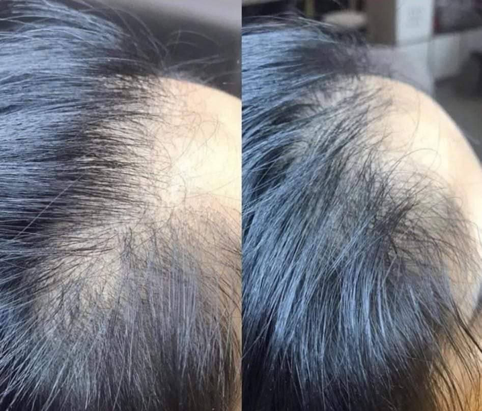 خلال سبوعين سبوعين لااكثر إذا مصار شعرج هيج أن بلخدمه
يطول شعر بشكل فضيع 😍✌️🏻

يمنعلج التساقط 

يكثف شعرج 

وينعمه ويلمعه شتريدين بعد أكثر سندوسه😉💜

يصير شعرج بطولج بالله العظيم 😍✌️🏻   دخذي واحد والثاني كد ماراح يعجبج الزيت غصب عليج راح ترجعين وتشترينه مني 🙊🥺😍وتوصيل لجميع محفظات 🚗🔥 بقيه البيجات عزلوا احسسلكم👍🏻❌

تعاي خاص ومعليج بل باقي توصيل جميع لمحفظات موجود لحجز ع خاص امنت الله ورسوله زيت مجرب وجربت ع شعري ومشالله نصحكم بيه كلش تاخذي تدعلي شرط ولله علفرق يشهدلله يجننن يجننن


**إذا كنت صاحب هذا الإعلان وتريد حذفه لأي سبب، رجاءا أرسل رسالة إلى الدعم الفني**