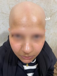 الثعلبة • صور قبل وبعد • د. حاتم الهيتي