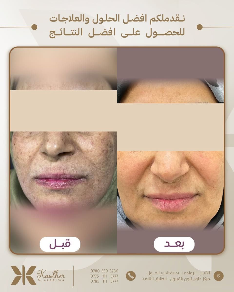 معالجة العديد من الحالات الجلدية ♥️
نحرص دائماً على تقديم رعاية متكاملة وشاملة لمختلف الحالات الجلدية، باستخدام أحدث التقنيات الطبية 🤎😍
•••••
العنوان📍: الأنبـار - الرمادي - بداية شارع المــول - مركز داون تاون بافيلون - الطابق الثاني
📱 للحجز والاستفسار الأتصال على:
📞 ***********
📞 ***********
📞 ***********

#عيادة_الدكتورة_كوثر_البلوة #جلدية #تجميل #ليزر
