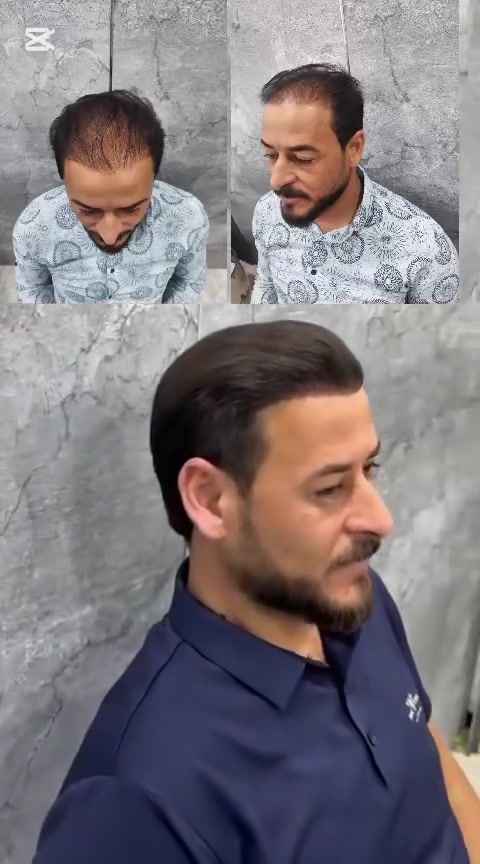 عيادة استيرا لزراعة الشعر والتجميل الانبار #الانبار#  رمادي # شارع المستودع # مجمع كابيتال طابق 3 مجاور مطعم امً تي  ***********
