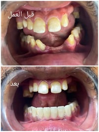 طبيب اسنان • تعويض اسنان • ابتسامة • تجميل اسنان • عيادة اسنان • ديالى...