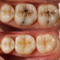 نعلن عن توفير علاج للاسنان مجاني فقط لفترة اسبوع بعد العيد مباشرتا سار...