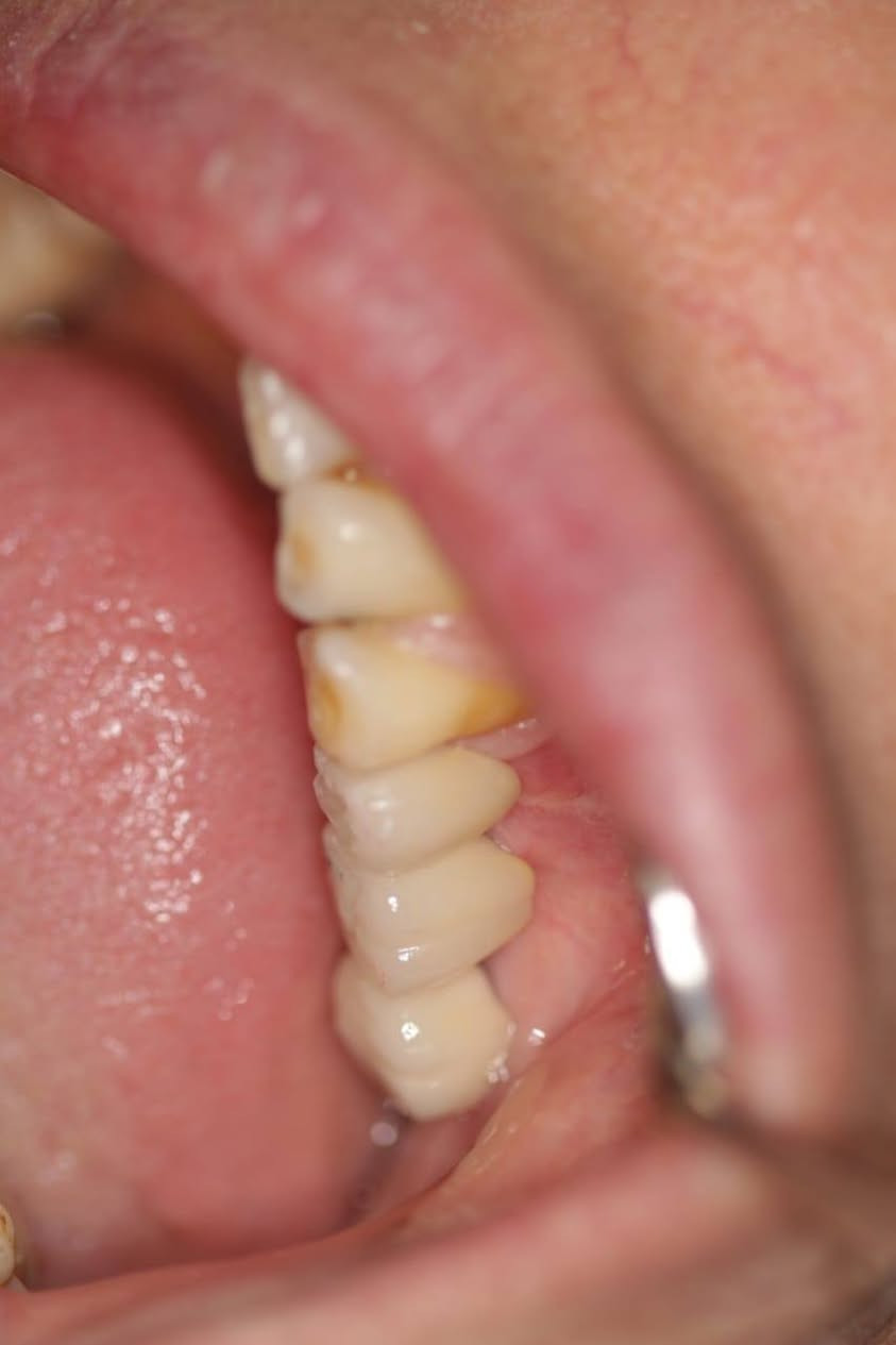 � العنوان: خانقين / تولةفروش / مقابل مسبح مرواري

🦷 ابتسامة مكتملة وطبيعية.. لأن تفاصيلك تهمنا! ✨

في عيادة الدكتور محمد خداداد، نؤمن أن الابتسامة الجميلة تبدأ من صحة الأسنان ودقة الاختيار.

نشارككم اليوم إحدى حالاتنا المتميزة:

🔹 الإجراء: زراعة زرعتين سنيتين لتعويض ثلاثة أسنان مفقودة.

🔹 المادة المستخدمة: أفضل وأجود أنواع الزركون (Zirconia)، المعروف بصلابته العالية ومظهره الطبيعي.

🔹 النتيجة: تعويض ثلاثة أسنان بمظهر طبيعي وانسجام تام مع بقية الأسنان، مع استعادة الوظيفة الحيوية والابتسامة بأفضل شكل ممكن.

💡 لماذا الزركون؟ لأنه يجمع بين القوة المتناهية والشفافية الطبيعية التي تجعله لا يختلف عن أسنانك الحقيقية.

📍 عيادة الدكتور محمد خداداد

نستقبلكم بكل حب لتقديم أفضل خدمات طب وتجميل الأسنان:
🦷 حشوات الأسنان (العلاجية والتجميلية)
🦷 تنظيف وتبييض الأسنان بالليزر
✨ تغليف الأسنان (التعويضية والتجميلية)
🌱 زراعة الأسنان بأحدث التقنيات
🩺 قلع الأسنان والجراحة المبسطة

📞 للحجز والاستفسار:
رقم الهاتف: ***********

📍 العنوان: خانقين / تولةفروش / مقابل مسبح مروار
