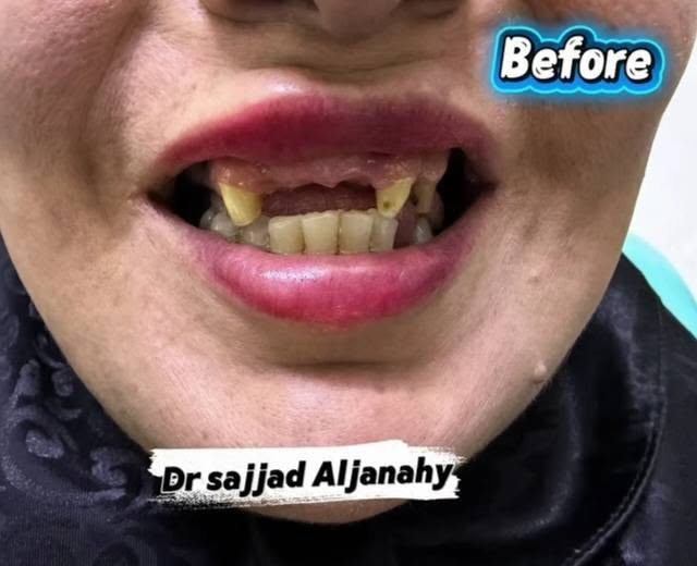 خلي ابتسامتك تبدأ ويانه! 🦷😀
تعلن عيادة الدكتور  الدكتور سجاد حسين الجناحي    Dr. Sajjad Hussain Al-janahy  عن تقديم أفضل الخدمات العلاجية والتجميلية حرصًا منا على راحتكم وصحة أسنانكم. ❤. 🦷

🔹 خدماتنا تشمل:
• تنظيف وتلميع الأسنان 🦷
• حشوات تجميلية وعلاج التسوس 🦷
• سحب العصب وعلاج الألم 🦷
• قلع الأسنان والجراحة 🦷
• تركيبات ثابتة ومتحركة 🦷
• زراعةوتقويم الاسنان 🦷
• تبييض الأسنان 🦷
• علاج لثة ونزف اللثة
• متابعة وعلاج أسنان الأطفال
وباسعار مناسبة ❤🦷

📍 العنوان: [ مجمع مجمع الحياة الطبي شارع السوداني مقابيل اسواق ابو علاء. ]
📞 للحجز والاستفسار: [***********]

🌟 لأن ابتسامتكم تهمنا… نهتم بأدق التفاصيل لنمنحكم الراحة والثقة.
 👇... 
Sajjad Al-Janahy 
دبلوم مهني تقويم الأسنان 
سيرتفيكيت زراعة الأسنان 
سيرتفيكيت تجميل الأسنان
