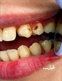 حشوة ضوئية • أسنان أمامية • ابتسامة