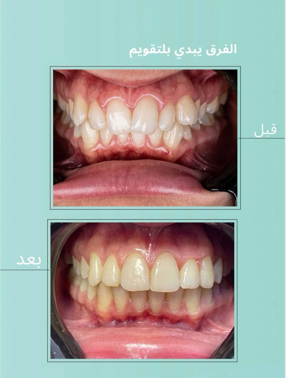 من أول زيارة إلى آخر موعد… كانت النتيجة ابتسامة تستحق كل خطوة ونشارككم إحدى رحلات التقويم الناجحة التي انتهت بنتيجة مميزة.

بإشراف الدكتورة آية عاصم

متواجدين يومياً من الساعة ٤ العصر وحتى الساعة ٩ مساء 

عيادة الإتقان لزراعة وتقويم الأسنان 

نستقبلكم بكل حب يومياً

للحجز والأستفسار الاتصال
***********

الطوبچي / مقابيل كوكتيل البركة، بداخل فرع صيدلية الابتغاء

#بغداد #عيادة_اسنان #عيادة_الإتقان⁩⁩⁩⁩⁩⁩⁩
