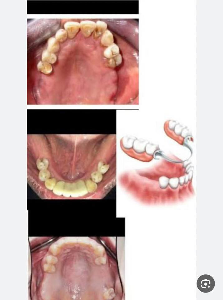 السلام عليكم ورحمة الله وبركاته
يتوفر حالياً إعداد وصناعة طقم أسنان لتعويض الأسنان المفقودة كما هو موضح في الصور، وذلك بشكل مجاني بالكامل ويشمل جميع مراحل العلاج، تحت إشراف أطباء اختصاص.

من كان لديه فقدان سنّين أو ثلاثة أسنان ويرغب في تعويضها، يُرجى التواصل للاستفسار على الرقم الآتي:
***********.
