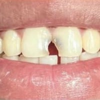 لمن لديه الحالات التالية من التسوس ويرغب في علاجها بسعر رمزي جدًا التو...