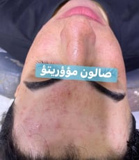 رؤوس سوداء • تقليص المسام • ناصرية قضاء النصر