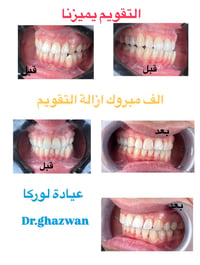 التقويم يميزنا احد حالات التقويم الف مبروك ازالة الجهاز و النتائج روعة...
