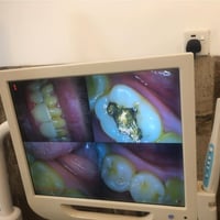 اجانه مراجع يريد يبدل  حشوة معدنية بحشوة بيضة  شرح للمراجع خطة العلاج ...