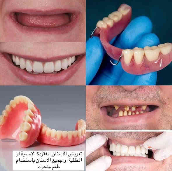 أقدّم خدمات علاجية وتجميلية 📍مجاناً داخل عيادات  الحكمة ، وبجودة عالية واهتمام كامل براحة المراجع.

الخدمات المتوفّرة:
• معالجة تسوّس الأسنان باستخدام الحشوات 
الضوئية

• تنظيف الأسنان وإزالة التكلسـات والتصبغات

• قلع الأسنان التالفة وبقايا الجذور

• تعويض الأسنان بطقم متحرك

• تعويض الأسنان الأمامية أو الخلفية بطقم متحرك

🔴العلاج مجاني(ابلاش) 
الموقع اليرموك شارع النادي الترفيهي. 

للتواصل ماسنجر https://m.me/AsmiaaShakir

واتس اب +9647733034684
