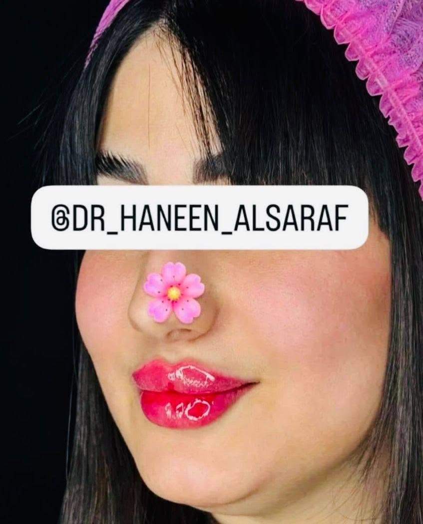 تحت إشراف الدكتورة [حنين الصراف] نقدم لكم أحدث تقنيات الحقن التجميلية بأعلى معايير الأمان والدقة للحصول على نتائج طبيعية تبرز جمالكِ الحقيقي دون مبالغة.
💎 بوتوكس 💎 فيلر الشفاه والخدود 💎 تحديد الكونتور والفك 💎 جلسات النضارة والترطيب العميق 💎 استشارات تجميلية متخصصة
✔️ خبرة واحترافية ✔️ مواد أصلية ومعتمدة ✔️ نتائج طبيعية تليق بجمالكِ
الدكتورة حنين الصراف 
كوني النسخة الأجمل من نفسكِ... فالجمال الراقي يبدأ مع الاختيار الصحيح. ✨🤍

💖  عنوان الجمال الراقي للسيدات
#تجميل #بوتوكس #فيلر #نضارة_البشرة #جمال_راقي #كوت

ورابط صفحة الطبيبة على الانستكرام:- 
‏https://www.instagram.com/dr_haneen_alsaraf/

رابط صفحة الطبيبة على الفيسبوك:- 
‏https://www.facebook.com/Haneenclinic1?mibextid=ZbWKwL

عنوان الطبيبة 
https://maps.apple/p/N9-Xe99xRLrvZf

📍 العنوان:- | العراق | الكوت | شارع الهورة | بناية ابن فنجان | مجمع الطبيب الجراح | الطابق الثاني

📞 للحجز والاستفسار:- 
***********
📞 ***********
📞 ***********
💖  عنوان الجمال الراقي للسيدات
#تجميل #بوتوكس #فيلر #نضارة_البشرة #جمال_راقي #كوت
تحت إشراف الدكتورة [حنين الصراف] نقدم لكم أحدث تقنيات الحقن التجميلية بأعلى معايير الأمان والدقة للحصول على نتائج طبيعية تبرز جمالكِ الحقيقي دون مبالغة.
