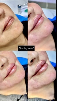 فلر شفة وتحديد ذقن💖 #مجمع ترف كلينك الطبي. العنوان مدينة الصدر خلف سوق...