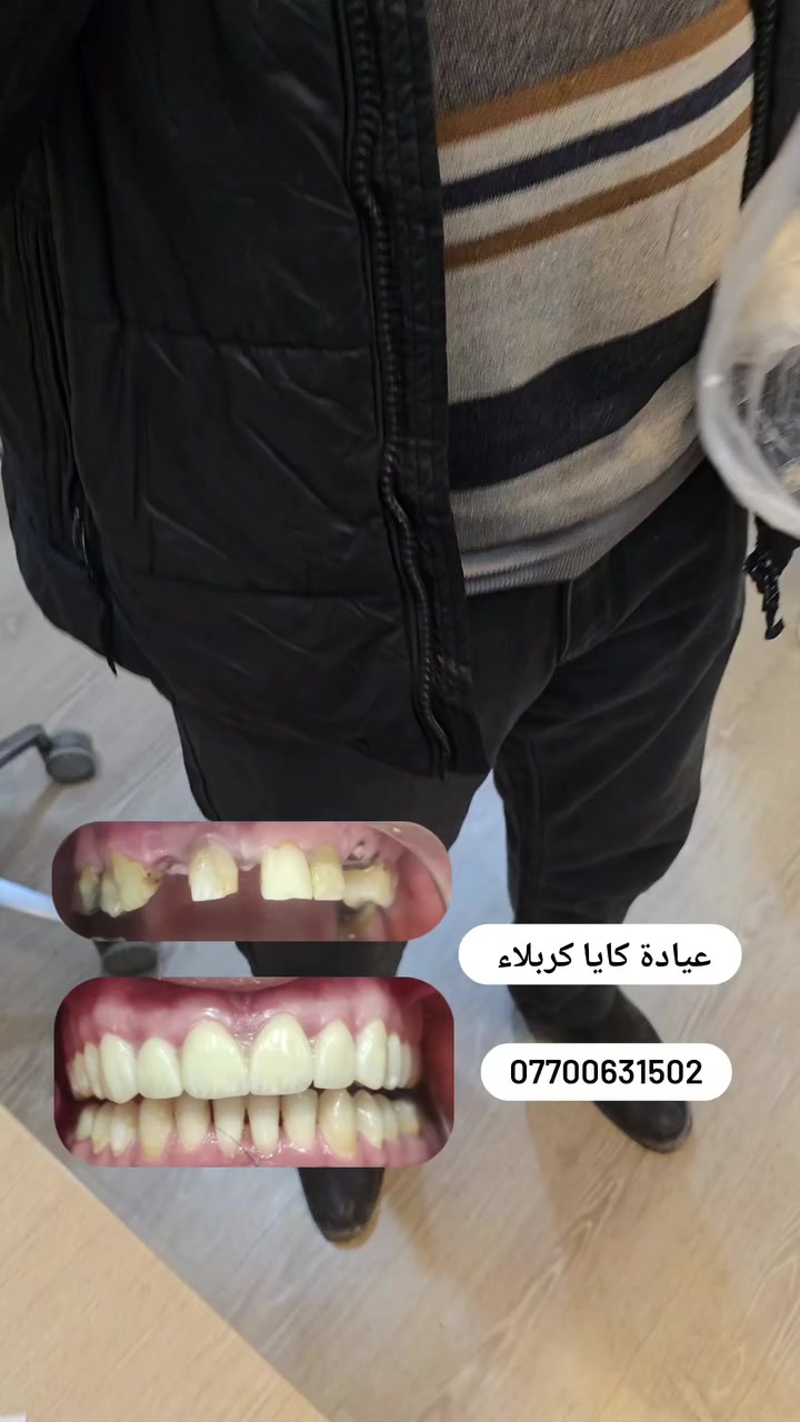 الصمونه والابتسامه 😁

رجعنالك الضحكة والوجبة الطيبة! 😁🥖
> مو بس شكل الأسنان مهم، الأهم هو شلون تقدر تاكل براحتك وتستمتع بوجباتك المفضلة. حجينا العزيز جرب التركيبات الثابتة في عيادة كايا، والنتيجة؟ صمون حار وكأنه أسنانه الطبيعية!
> ✅ تركيبات زركون وفينير بأحدث التقنيات.
> ✅ دقة عالية في التنفيذ وبدون ألم.
> ✅ ابتسامة طبيعية 100%.
> 📍 العنوان: كربلاء - [شارع الاسكان مجمع الهادي الطبي ]
> 📞 للحجز والاستفسار: ***********
> عيادة كايا كربلاء - نعتني بابتسامتكم.
