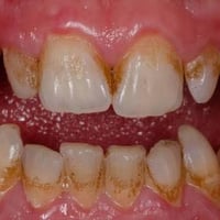 العلاج مجانا تنضيف الاسنان من التكلسات والتصبغات للحجز على الخاص او عل...