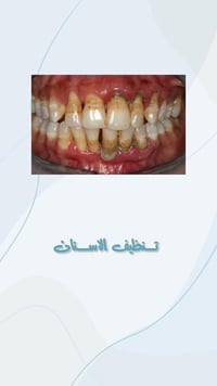 عرض مجاني لفترة محدودة للتنظيف الاسنان للحجز والاستفسار التواصل 0777 3...