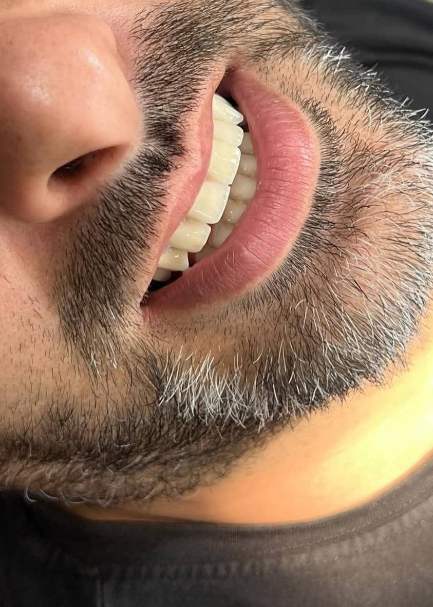 ابتسامة  ساحره وثقة مضاعفه 🩵🔥 عيادتنا فرع حي النصر 🔥🔥

تعويض الاسنان باستخدام (الزاركون   ألالماني) لمراجعتنا أبو ادم  من حي النصر 

على يد 
الطبيب الاختصاص
د.يوسف الهدلي 
( ماجستير في طب ومعالجة الاسنان) 
خلي ابتسامتك ويانه احلى 🩵

أبتسامتك ~ يم عيادات الفرح لطب وتجميل الأسنان ~ غير ✨😍

علماً كافة الابتسامات والحشوات مع ضمان مدى الحياة 😎

للإتصال 📞📞 
فرع حي النصر
#العنوان
حي النصر/ شارع الاطباء / قرب جامع الأمام المهدي
فوق صيدلية مصطفى جاسم أو أسواق الزعيم 

للحجز والاستفسار 

*********** ☎️

دوام العياده ⏰
فرع حي النصر 
من الساعه 4  عصرا 
إلى 
الساعه 9 مساءا
