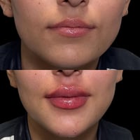 دكتورة فاطمة • فلر • بوتوكس • نضارة بشرة • حقن فلر • حقن بوتوكس • تجمي...
