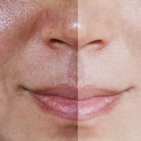 مرحبا.....  .موضوعنة اليوم عن الكلف الي هو مشكلة الكثير من النساء واحي...