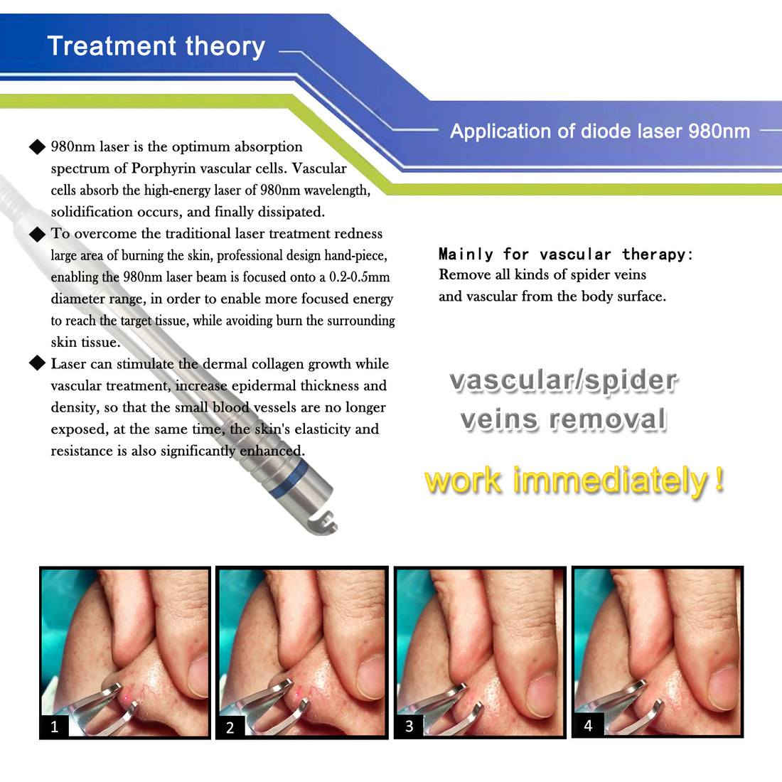هذا الجزء من الصورة يوضح جهاز ليزر الصمام الثنائي (Diode Laser) بطول موجي 980 نانومتر، وهو مخصص بشكل أساسي لإزالة الأوردة العنكبوتية (Spider Veins).
إليك أبرز التفاصيل المتعلقة بهذا الجهاز بناءً على دليل الاستخدام المرفق:
وظيفة الجهاز
يُستخدم الجهاز لعلاج المشاكل الوعائية السطحية، حيث يعمل الليزر على استهداف الهيموجلوبين في الدم لإغلاق الأوردة الصغيرة دون إتلاف الجلد المحيط.
احتياطات السلامة (المذكورة في الدليل)
تجنب النظر المباشر: لا تنظر أبداً إلى مخرج الليزر في المقبض أثناء تشغيل الجهاز.
التوجيه الصحيح: لا توجه الليزر نحو الجسم بشكل مستمر في نقطة واحدة لتجنب الحروق.
العناية بالألياف: عدم ثني سلك الألياف الضوئية أو سحبه بقوة لتجنب تلفه.
المعايير الدولية: يجب اتباع جميع احتياطات السلامة الخاصة بأجهزة الليزر من الفئة الرابعة (Class IV).
ملاحظة هامة: هذا النوع من الأجهزة يتطلب تدريباً متخصصاً وخبرة طبية لاستخدامه بشكل آمن وفعال. يُنصح دائماً باستشارة مختص قبل البدء بأي علاج.

-


**إذا كنت صاحب هذا الإعلان وتريد حذفه لأي سبب، رجاءا أرسل رسالة إلى الدعم الفني**