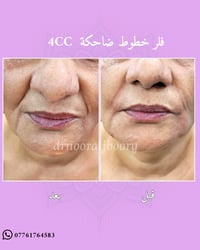 فلر خطوط ضاحكة  4cc د. نور الجبوري   الحجز والاستفسار 07761764583