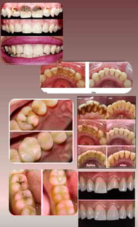 حشوات تجميلية • تنظيف اسنان • قلع اسنان مجاني